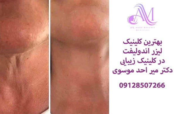 بهترین کلینیک لیزر اندولیفت