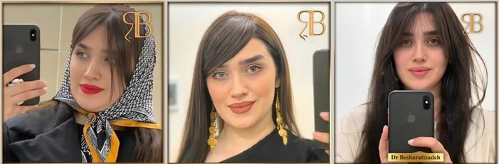 نمونه کارهای عمل بینی دکتر بشارتی زاده