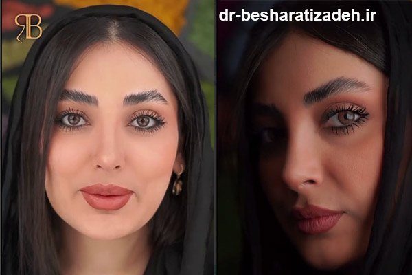 نمونه کار جراحی بینی دکتر بشارتی زاده
