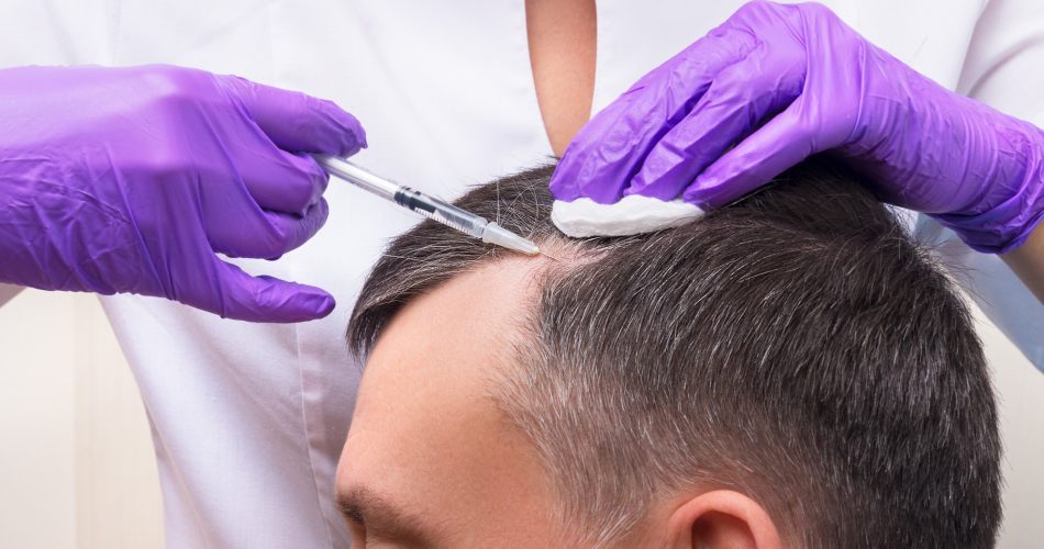 کاشت مو به روش DHI