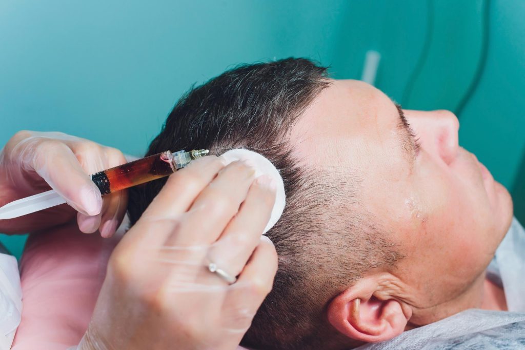 کاشت مو به روش دی اچ آی