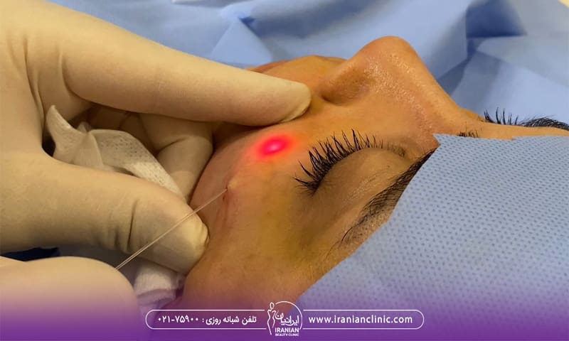 پزشکی که میکروفیبر لیزر اندولیفت را زیر گونه دختر فرو کرده و نور لیزر قرمز رنگ از زیر پوست او مشخص است - جوانسازی پوست با اندولیفت