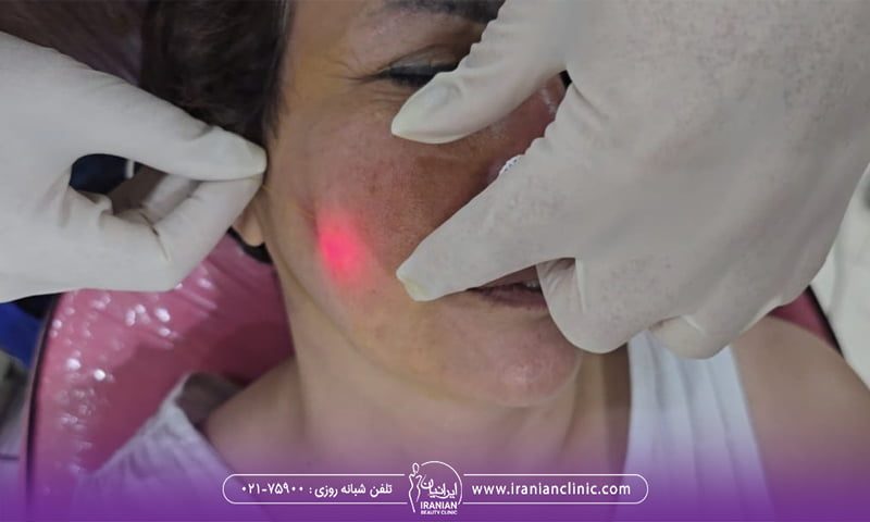 زنی که روی تخت کلینیک دراز کشیده و پزشک سمت راست صورت او را اندولیفت می کند