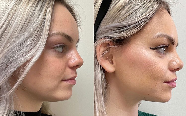 تفاوت اندولیفت با روش‌های سنتی لیفتینگ در کاهش افتادگی و جوان‌سازی پوست