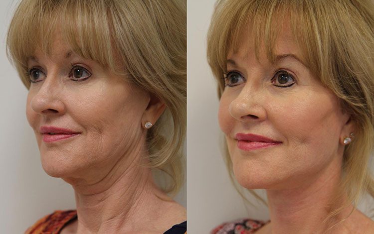 مزایای اندولیفت صورت نسبت به جراحی در بازگرداندن قوام و شادابی طبیعی پوست