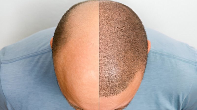 کاشت مو در شیراز یا تهران؟