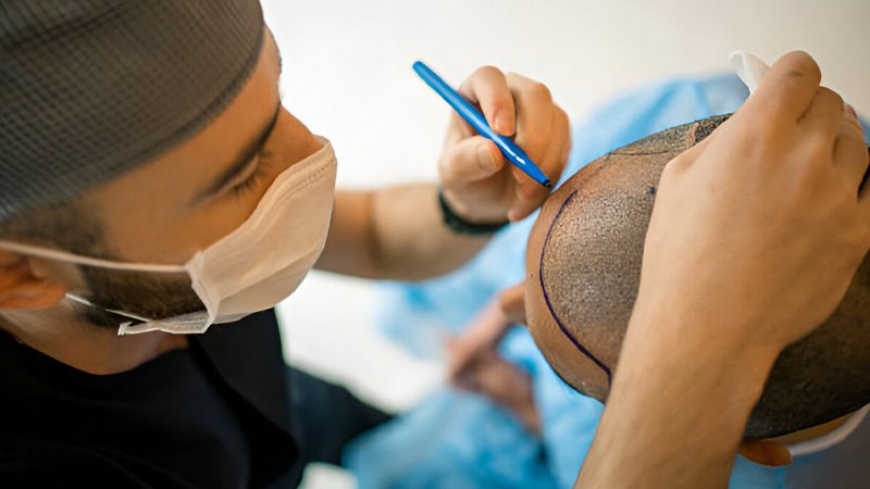 کاشت مو در شیراز