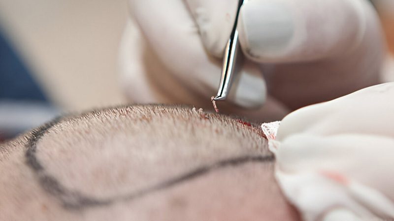 بهترین کلینیک کاشت مو در شیراز