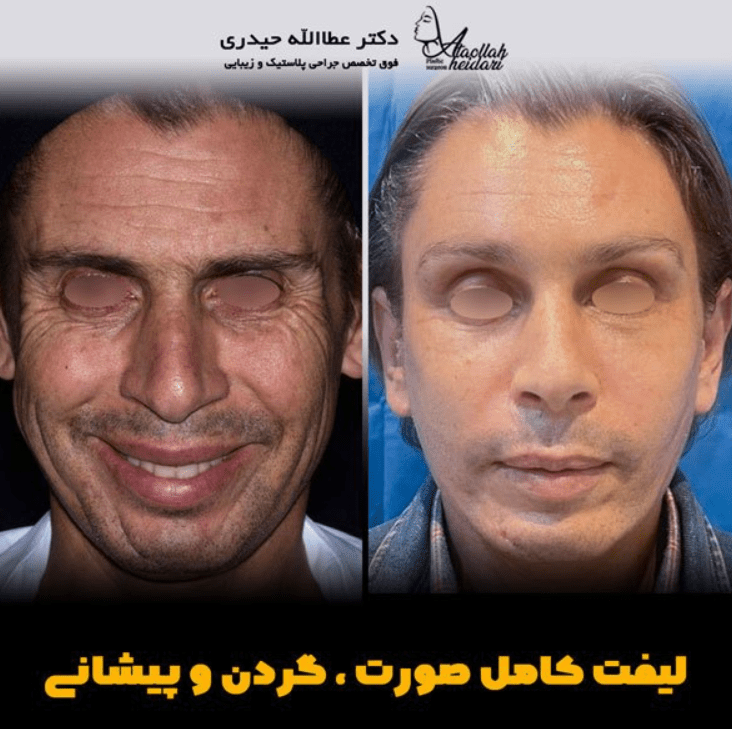 نمونه عمل لیفت صورت