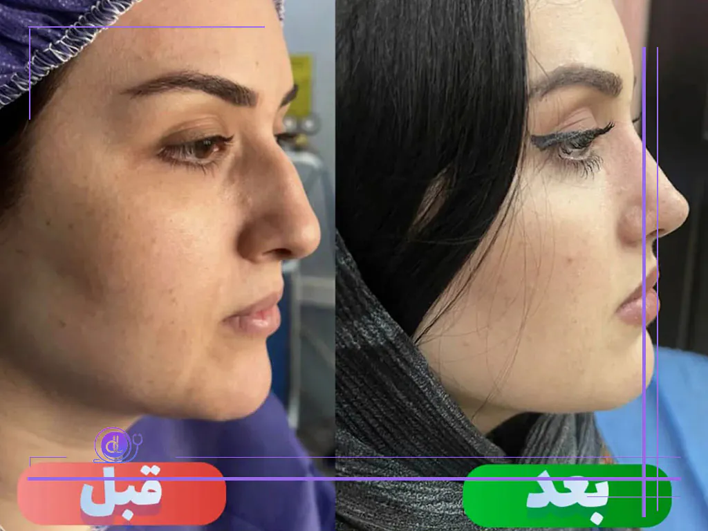 نمونه کار پرطرفدارترین جراح بینی در شیراز - دکتر وحید عین آبادی