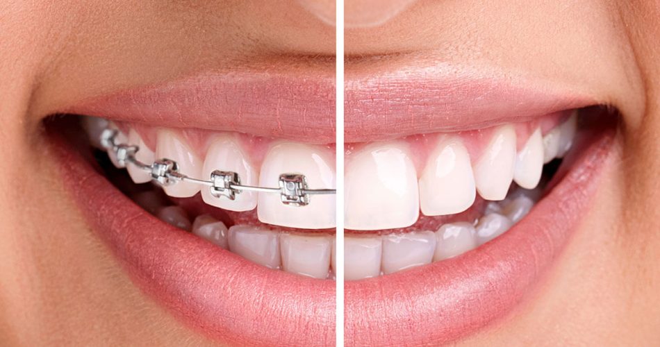 سریعترین روش مرتب کردن دندانها کدام است؟