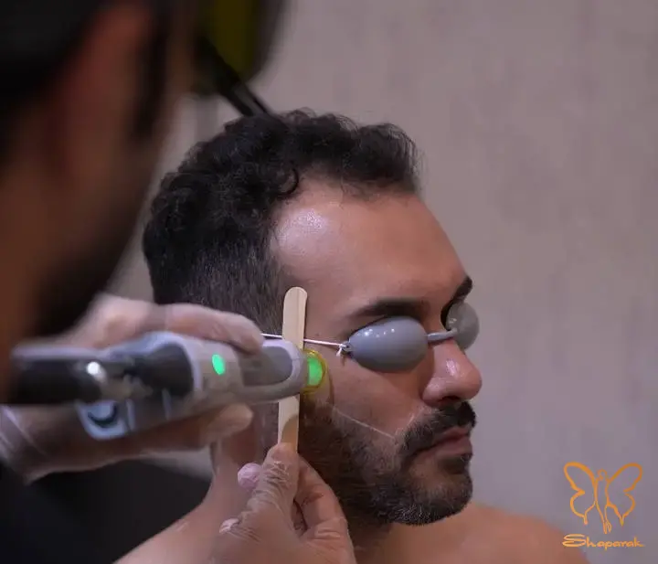 لیزر خط ریش در مشهد