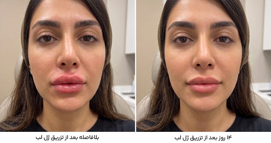 روند کاهش ورم ژل لب از روز اول تا روز چهاردهم