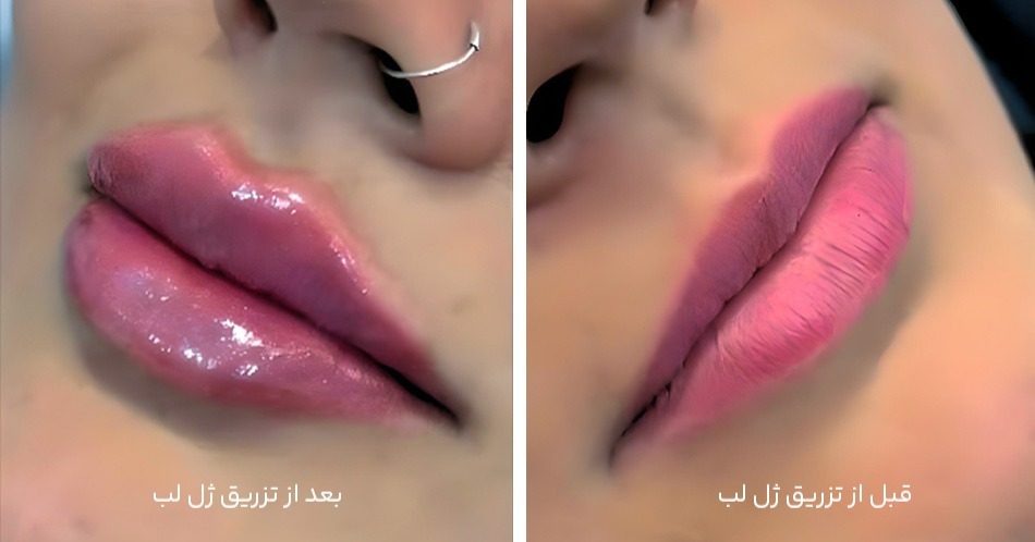 نمونه کار تزریق ژل لب در مشهد