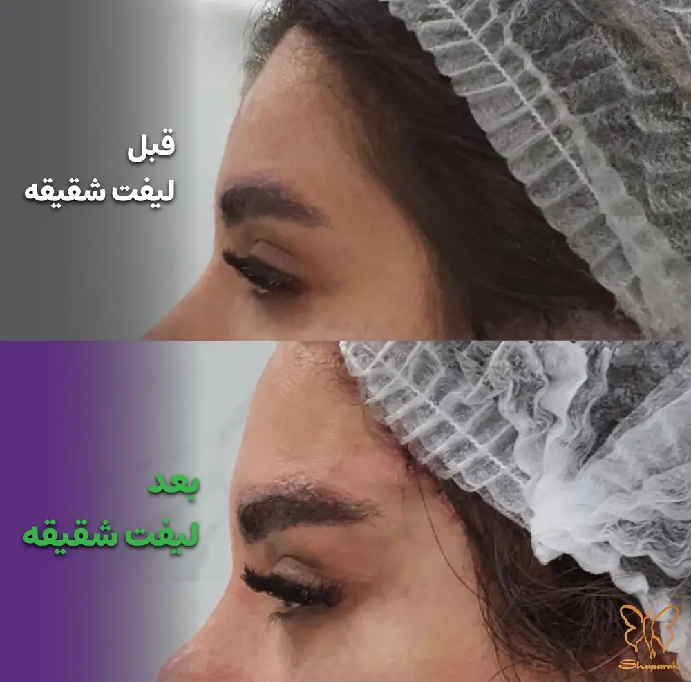 لیفت شقیقه مشهد
