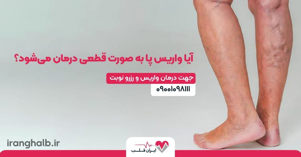 آیا واریس پا به صورت قطعی درمان می‌شود؟