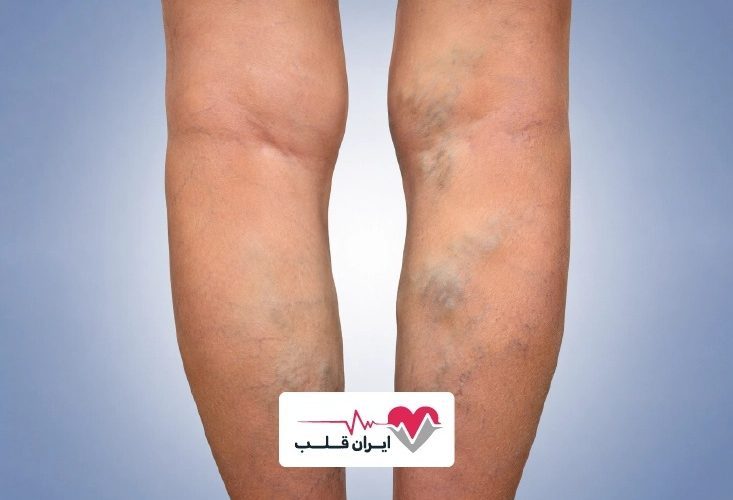 درمان واریس پا با بهترین متخصص واریس تهران