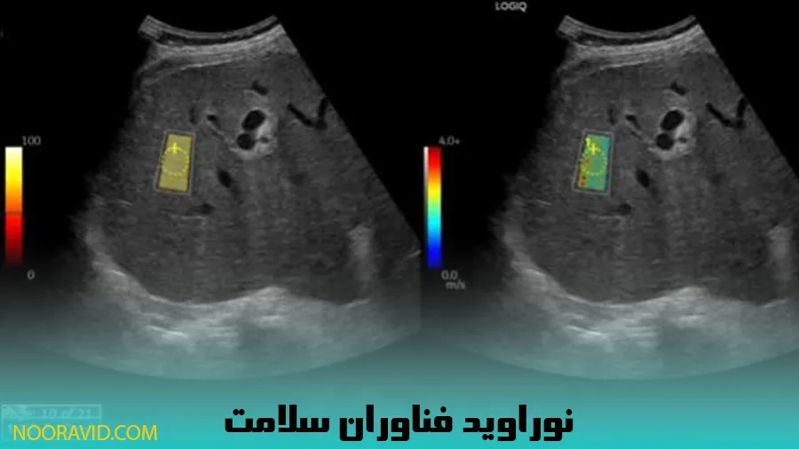 تصویر نتیجه الاستوگرافی