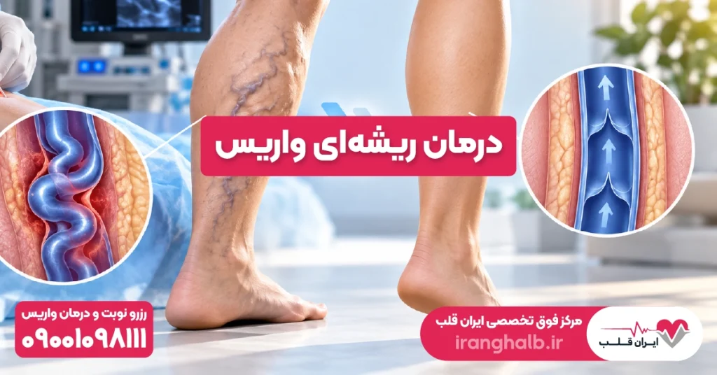 درمان ریشه‌ای واریس