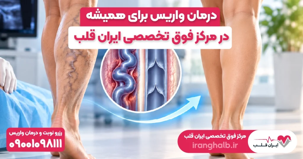 درمان واریس برای همیشه در مرکز فوق تخصصی ایران قلب