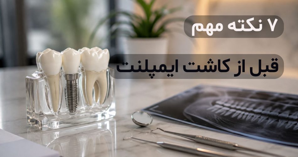 نکات مهم ایمپلنت دندان