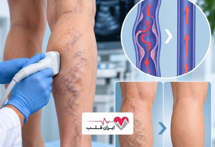 تحولی در درمان واریس | رفع رگهای واریسی بدون جراحی و با حداقل درد