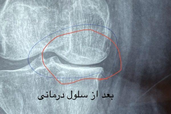 درمان آرتروز زانو و مفاصل بدن با سلول بنیادی مزانشیمال